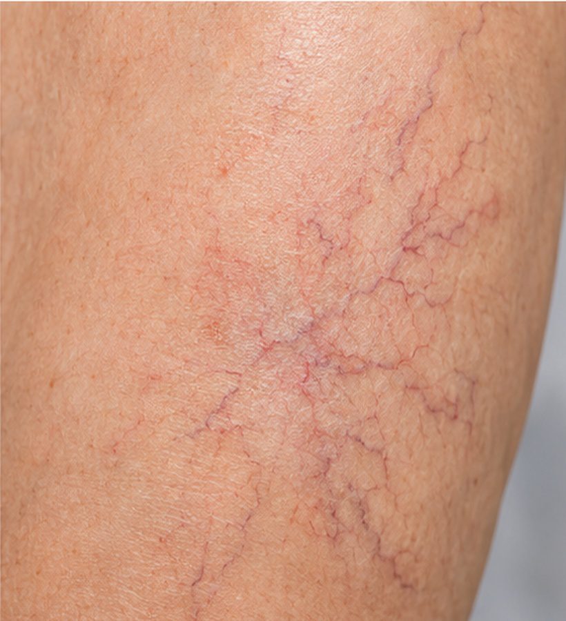 01_spider_veins