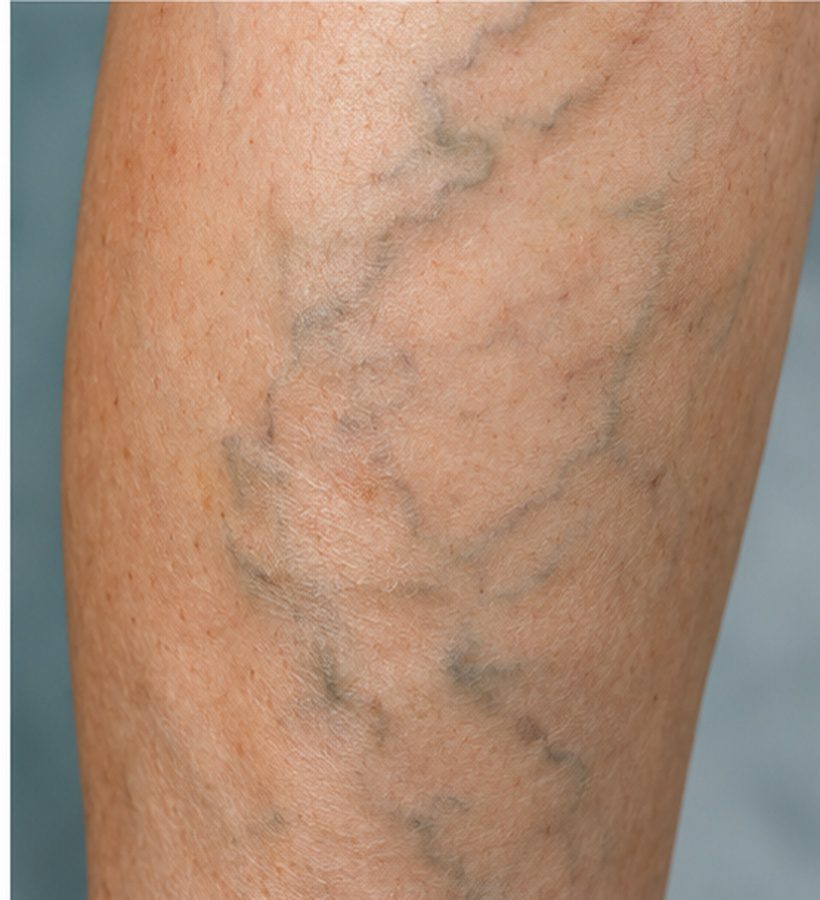 02_reticular_veins